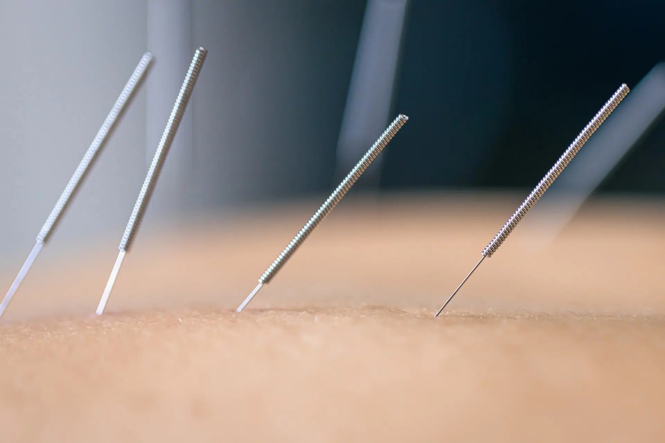 Medical acupuncture performed by a physiotherapist