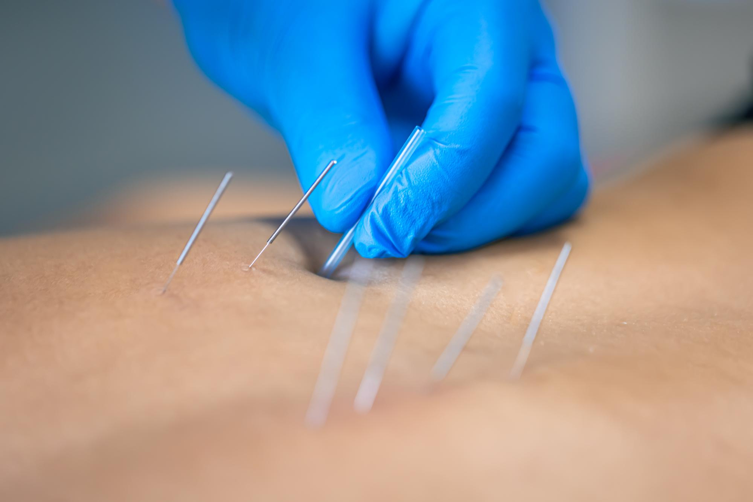 Close-up of acupuncture needles placed on the forearm